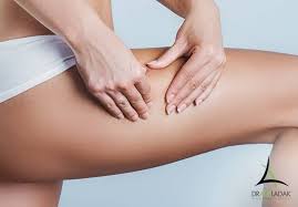 Easy Liposuction Tips For A Sculpted Body